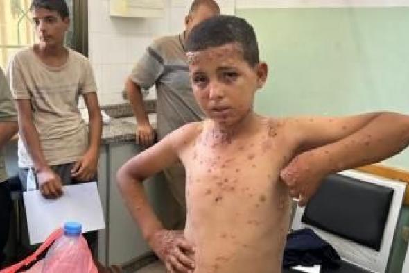 أخبار اليمن : الجرذان تفاقم الأمراض الجلدية في غزة
